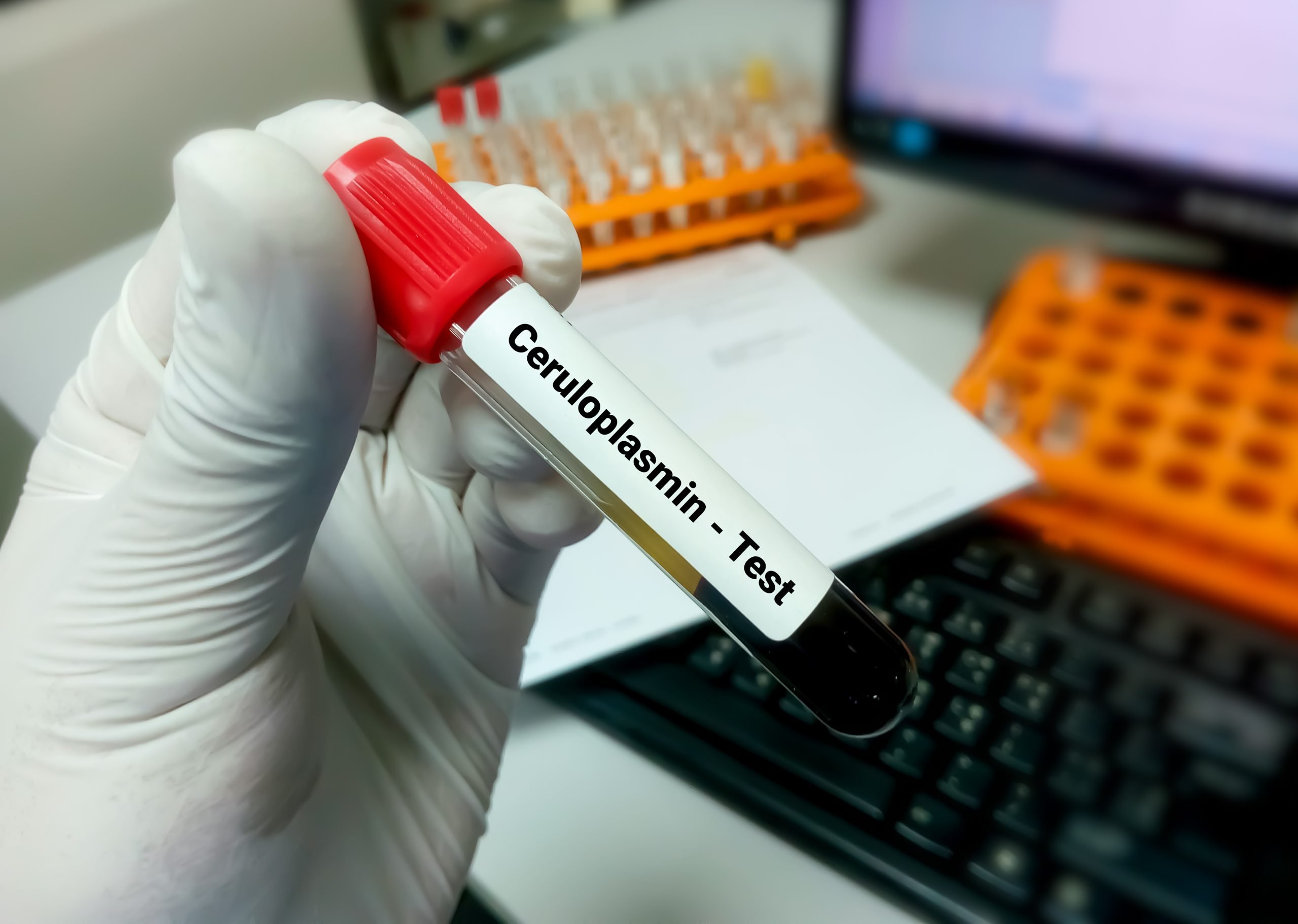 Ceruloplasmin Test In Hyderabad