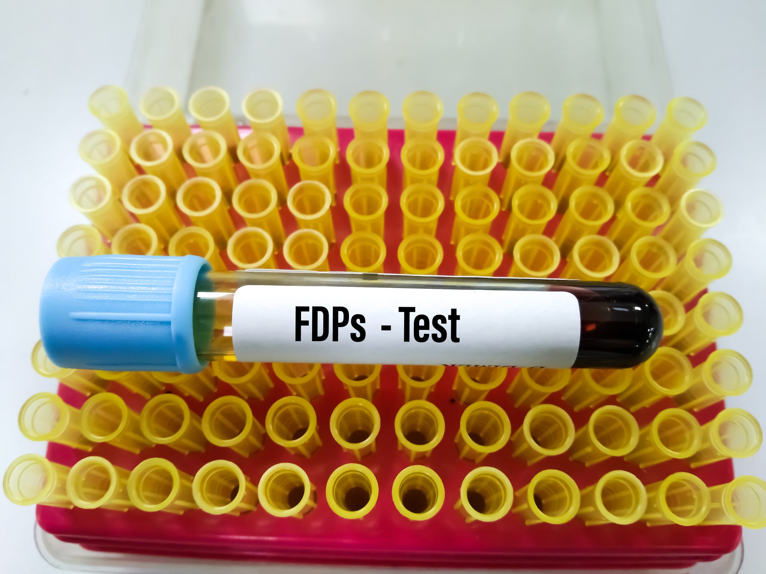 Fibrinogen Degradation Products Test In Bangalore