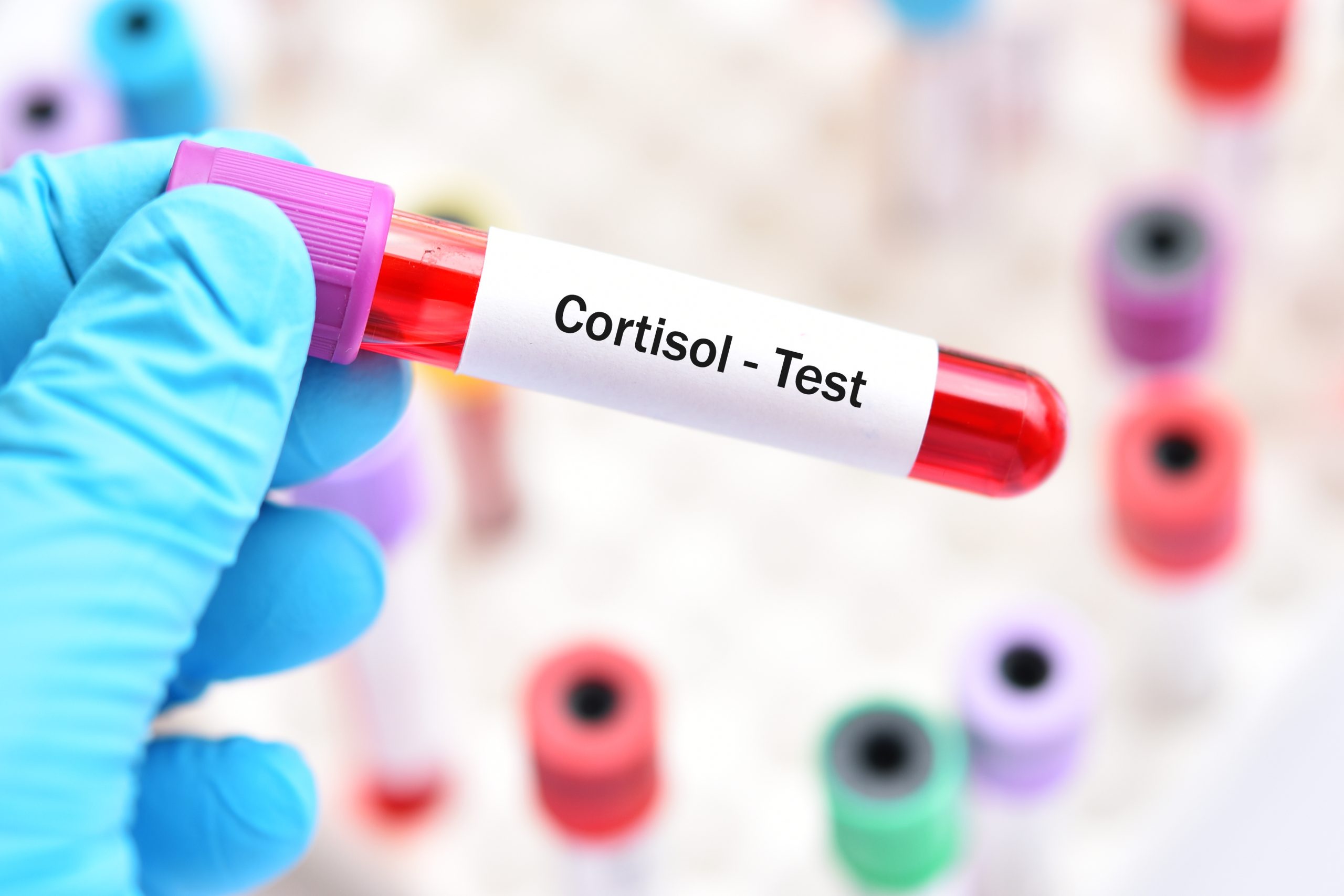 Cortisol Serum Test In Chandigarh